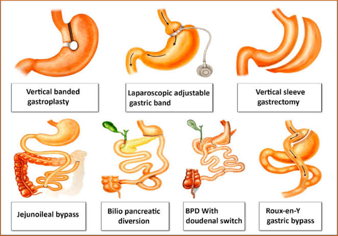 Bariatric Must Haves