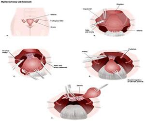 Hysterectomy Treatment in Chennai