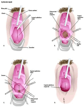 In this cystocele repair by anterior colporrhaphy, a speculum is used to hold open the vagina, and the cystocele is visualized (A). The wall of the vagina is cut open to reveal an opening in the supporting structures, or fascia (B). The defect is closed (C), and the vaginal skin is repaired (D). (Illustration by GGS Inc.)