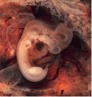Oviduct with an ectopic pregnancy (tubal pregnancy) showing a 1 month embryo