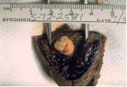 Another example of a tubal pregnancy (6 week old embryo)