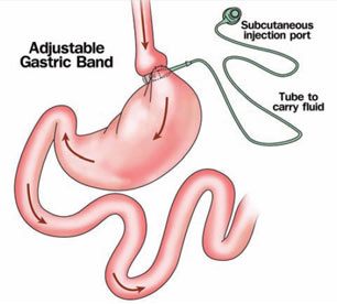 Laparoscopic Gastric Bypass Surgery in India