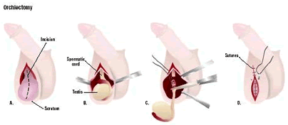 laparoscopic orchiectomy surgery india