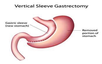 Gastrectomie manchon laparoscopique en Inde