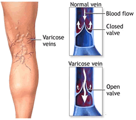 varicose operation cut viena