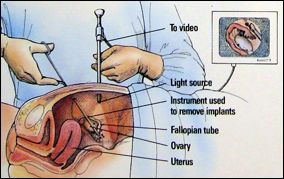 low cost endometriosis surgery in india