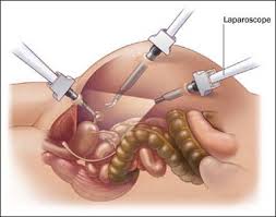 Laparoscopic Surgery Cost in India