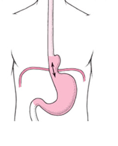 Low Cost Hiatus Hernia Repair Surgery in India