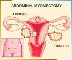 Low Cost Myomectomy Surgery in India