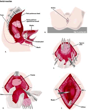 A tumor in the rectum or lower colon can be removed by a rectal resection (A). An incision is made around the patient's anus (B). The tumor is pulled down through the incision (C). An attached area of the colon is also removed (D). The area is repaired, leaving an opening for bowel elimination (E). (Illustration by GGS Inc.)