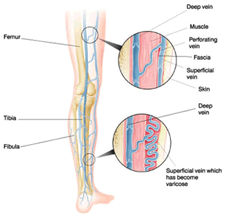 vericose-vein2