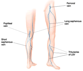 vericose-vein3