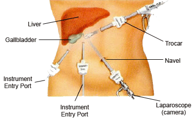 India Laparoscopy Surgery
